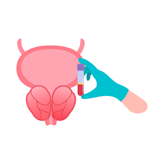 Was ist PSA (prostataspezifisches Antigen)? Werte, Bedeutung und Verlaufskontrolle