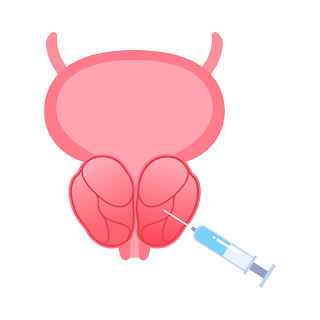 Was ist PSA (prostataspezifisches Antigen)? Werte, Bedeutung und Verlaufskontrolle